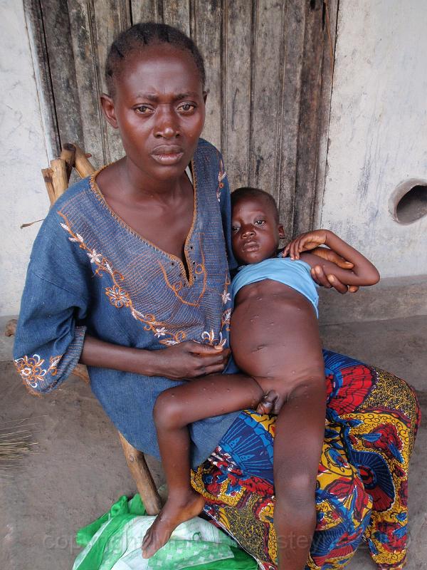 3 Mother with her boy who was contaminated with monkey pox.jpg